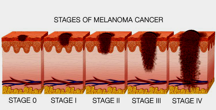 This is the initial stage and the cancer resides in the organ it belongs to. Size is up to 2 inches.