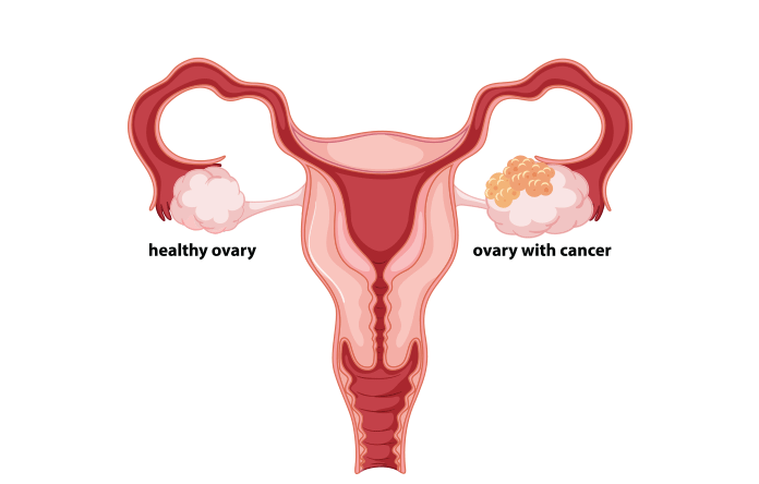 Ovarian cancer begins in the ovaries.