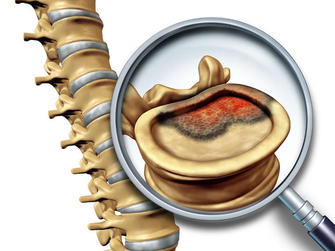 Spinal tumor is limited to spinal cord only